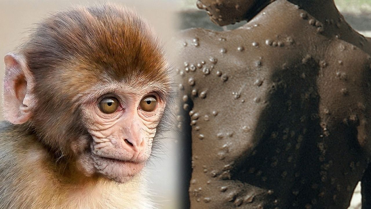 Francia y Alemania confirmaron sus primeros casos de viruela del mono
