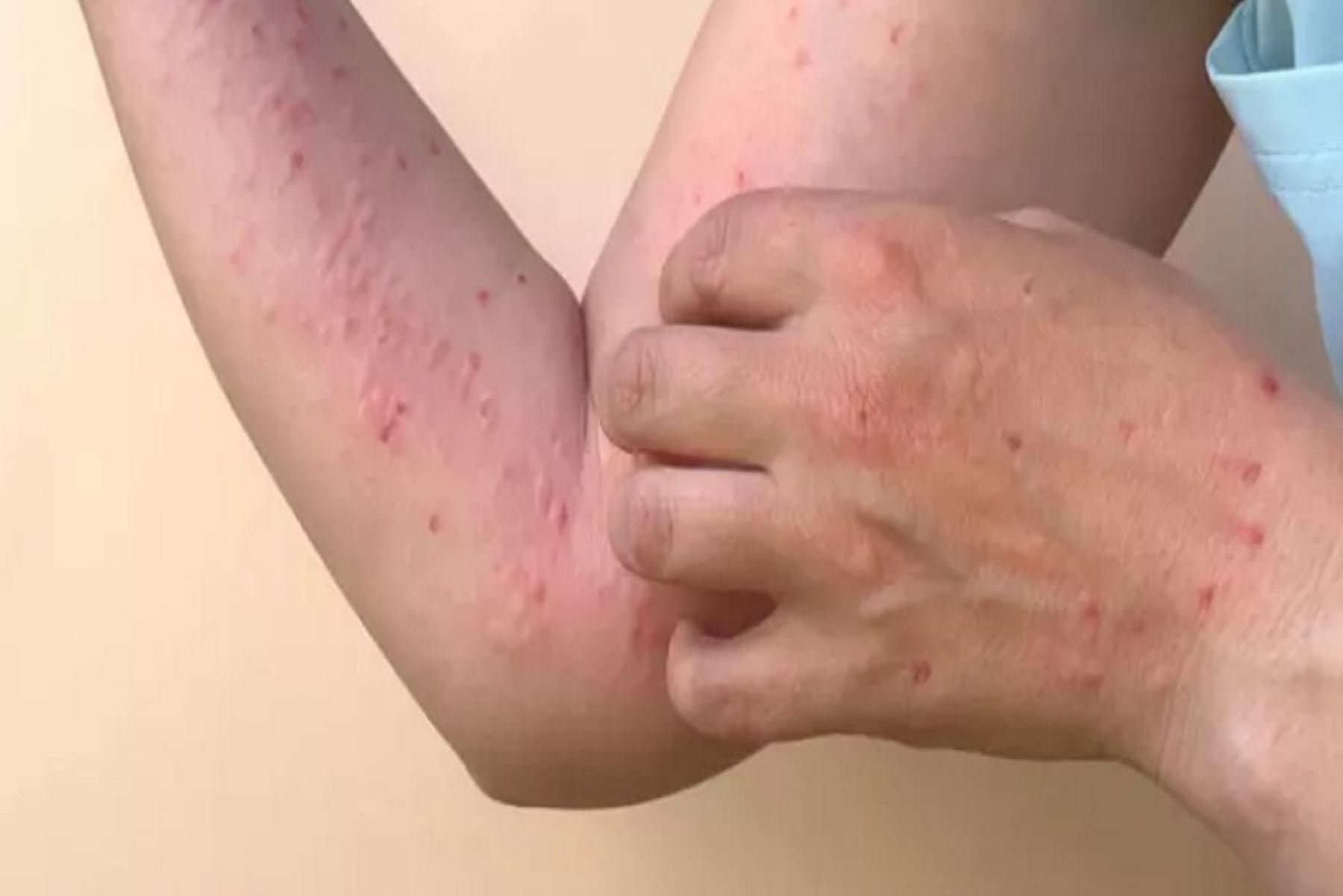 Casos de viruela del mono suben a 2587